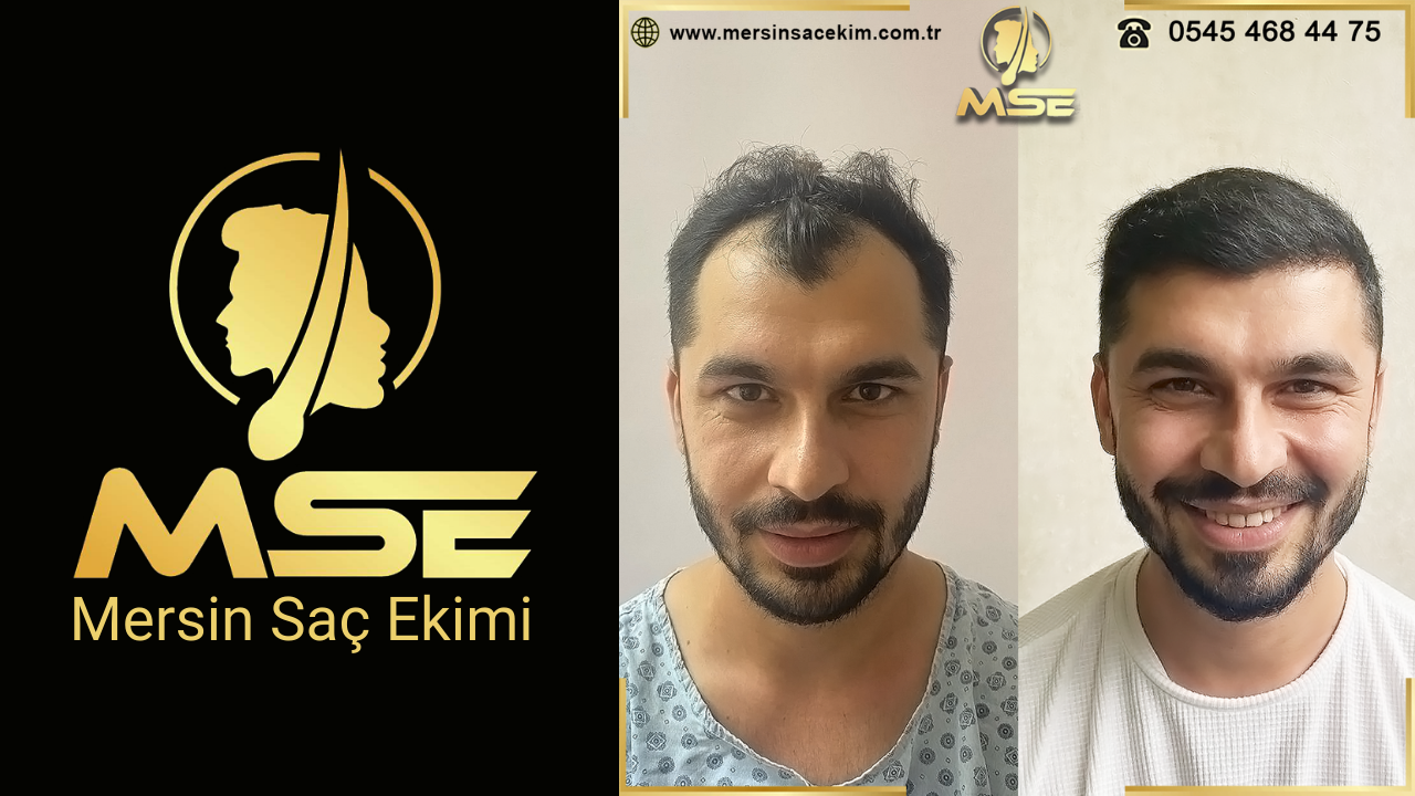 Mersin Saç Ekimi